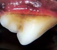 Stage 1 Periodontal Disease (Gingivitis)