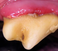Stage 2 (early) Periodontal Disease