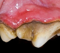 Stage 3 (moderate) Periodontal Disease